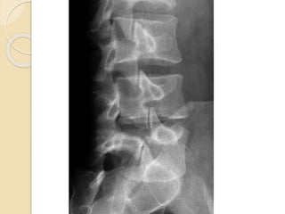 Degenerative disease of the spine