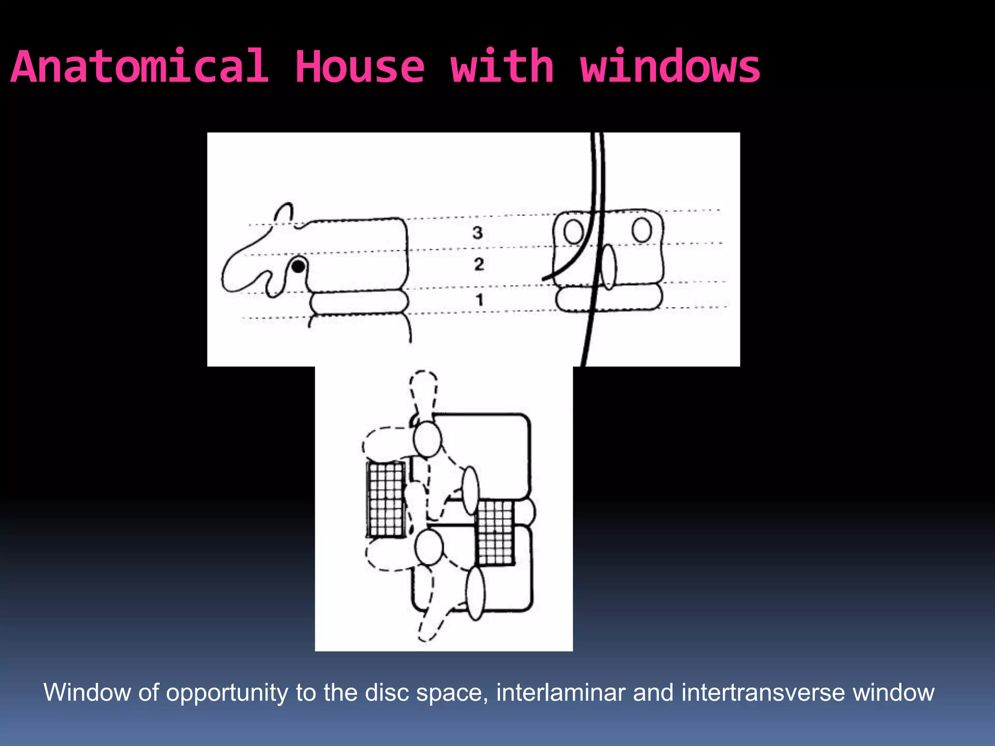 Anatomical House with windows

Window of opportunity to the disc space, interlaminar and intertransverse window

 