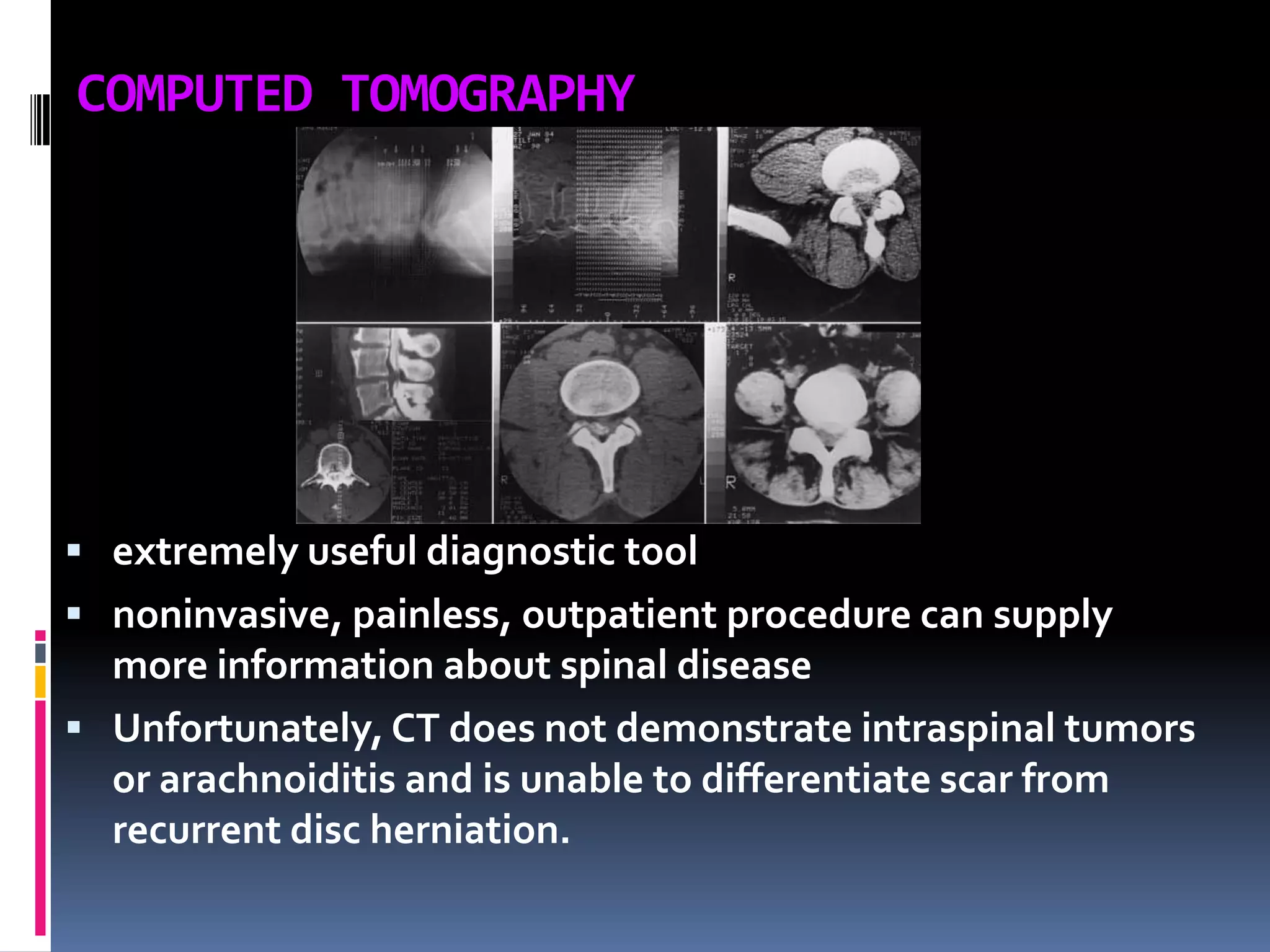 COMPUTED TOMOGRAPHY

 extremely useful diagnostic tool
 noninvasive, painless, outpatient procedure can supply

more information about spinal disease
 Unfortunately, CT does not demonstrate intraspinal tumors
or arachnoiditis and is unable to differentiate scar from
recurrent disc herniation.

 