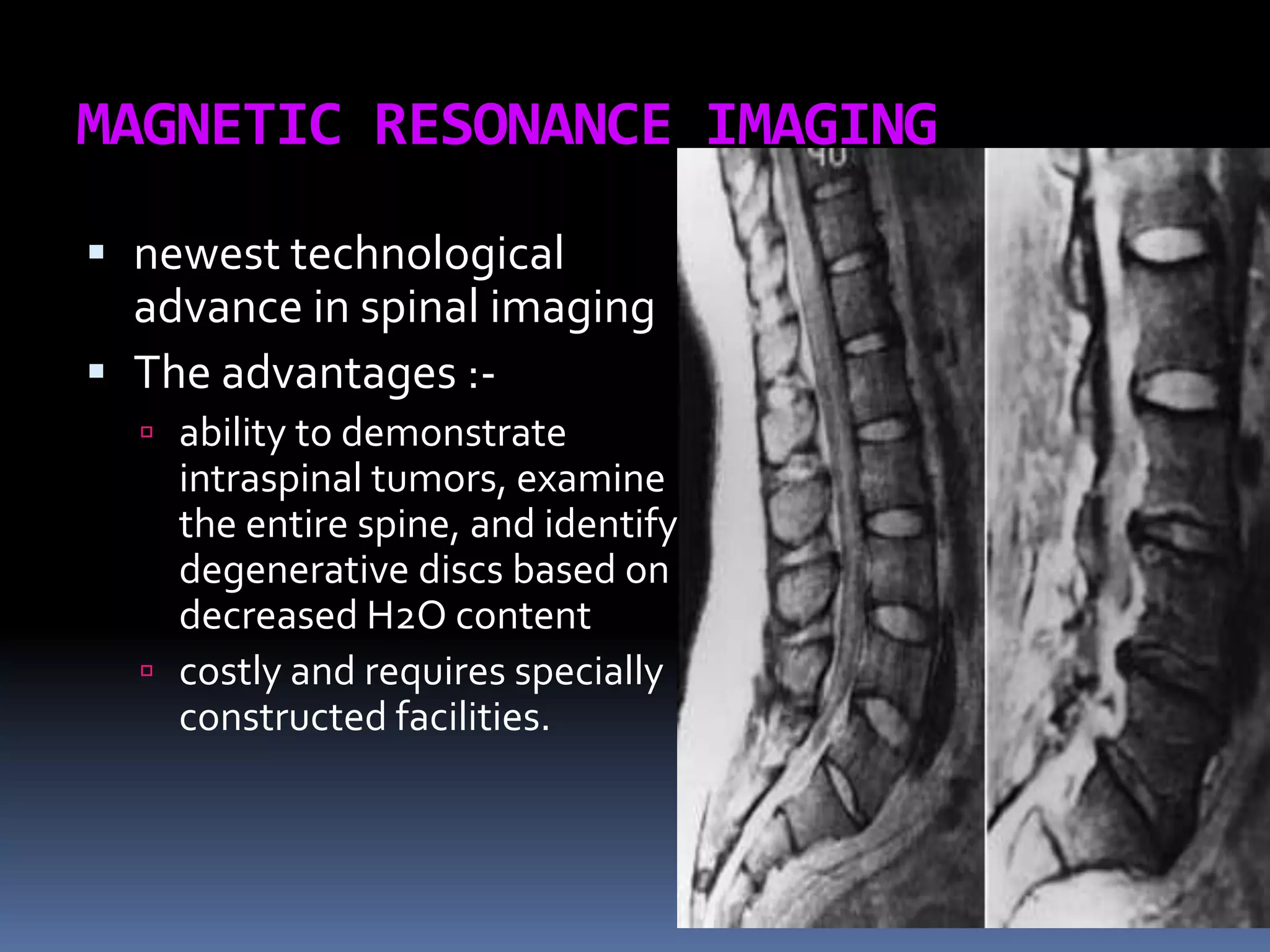 MAGNETIC RESONANCE IMAGING
 newest technological

advance in spinal imaging
 The advantages : ability to demonstrate

intraspinal tumors, examine
the entire spine, and identify
degenerative discs based on
decreased H2O content
 costly and requires specially
constructed facilities.

 