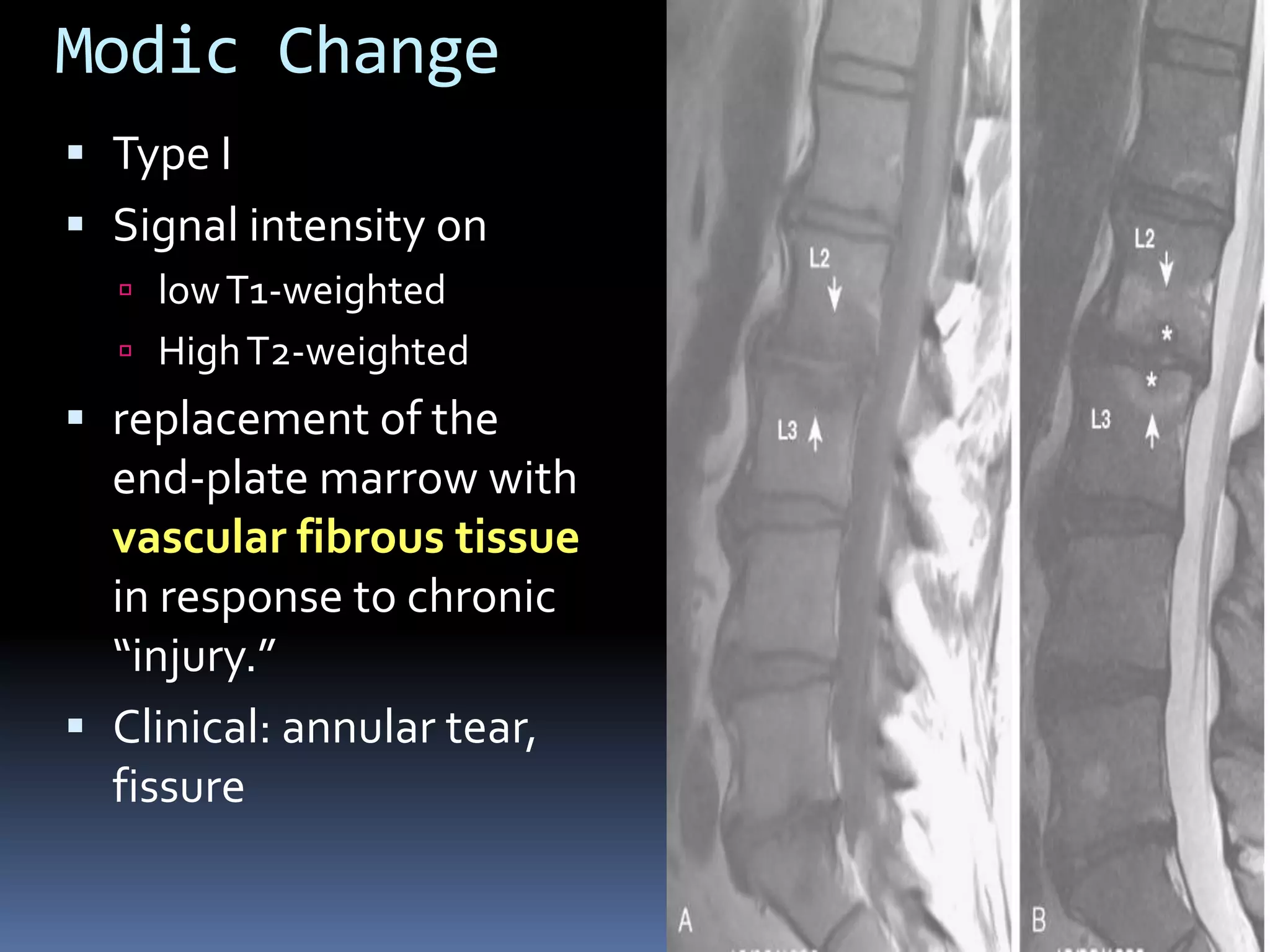 Modic Change
 Type I
 Signal intensity on
 low T1-weighted

 High T2-weighted

 replacement of the
end-plate marrow with

vascular fibrous tissue
in response to chronic
“injury.”
 Clinical: annular tear,
fissure

 