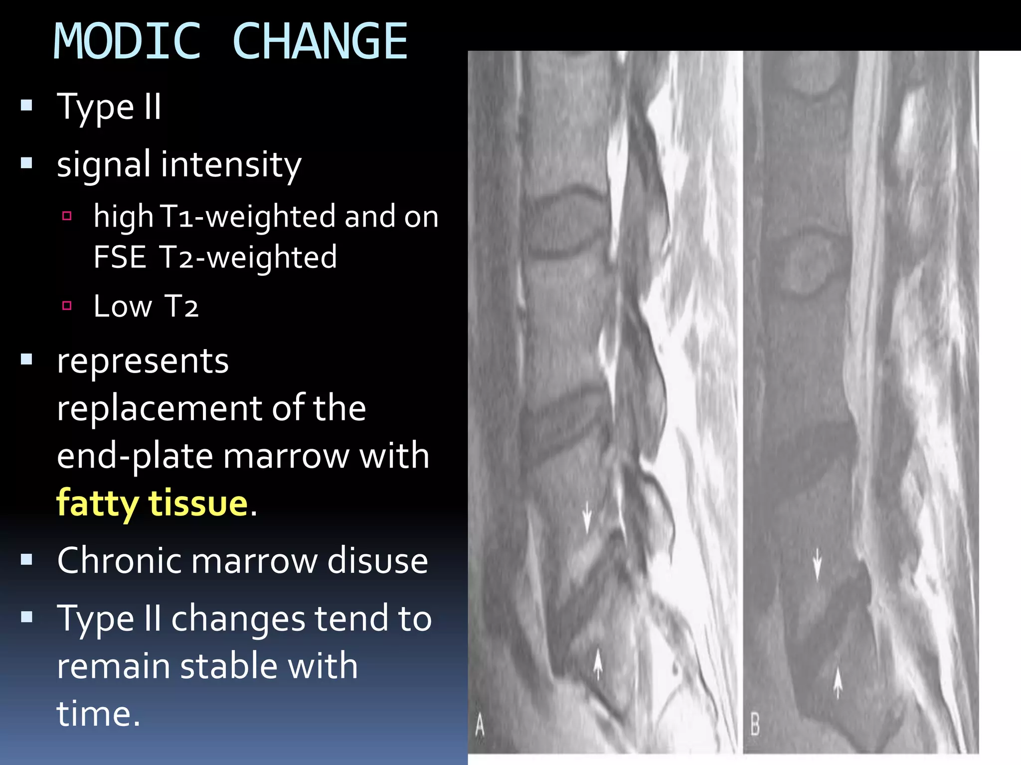 MODIC CHANGE
 Type II
 signal intensity
 high T1-weighted and on

FSE T2-weighted
 Low T2

 represents
replacement of the
end-plate marrow with
fatty tissue.
 Chronic marrow disuse

 Type II changes tend to
remain stable with
time.

 
