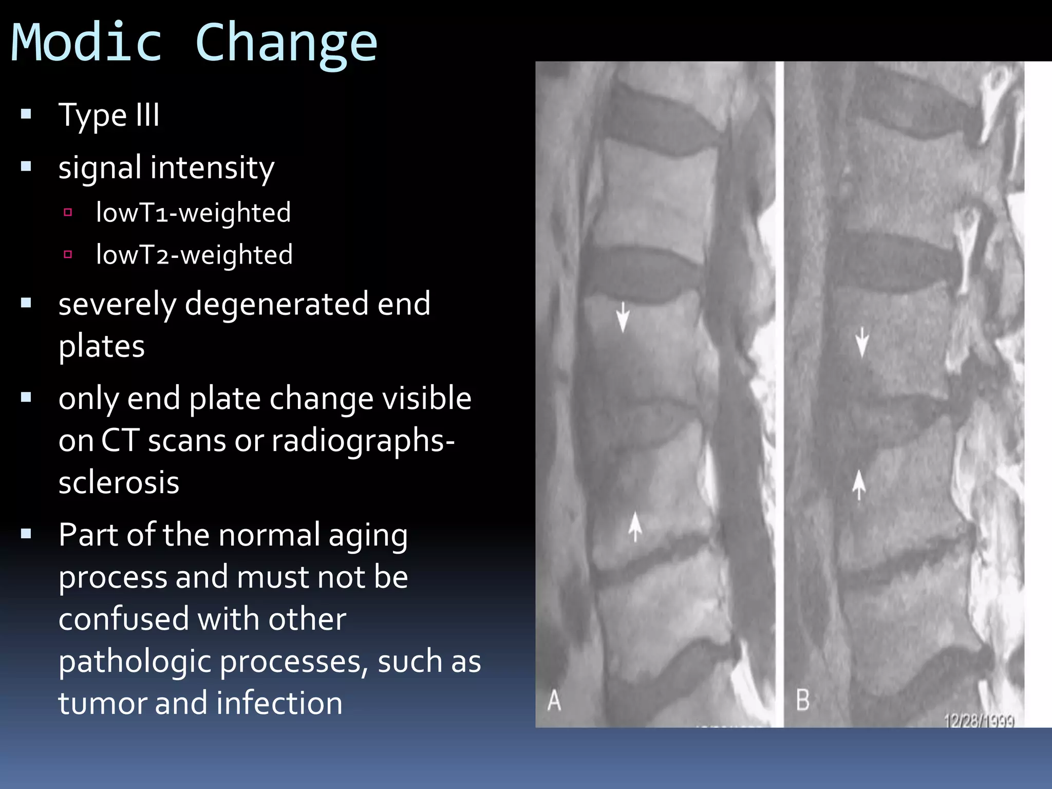 Modic Change
 Type III
 signal intensity
 lowT1-weighted
 lowT2-weighted

 severely degenerated end

plates
 only end plate change visible
on CT scans or radiographssclerosis
 Part of the normal aging
process and must not be
confused with other
pathologic processes, such as
tumor and infection

 