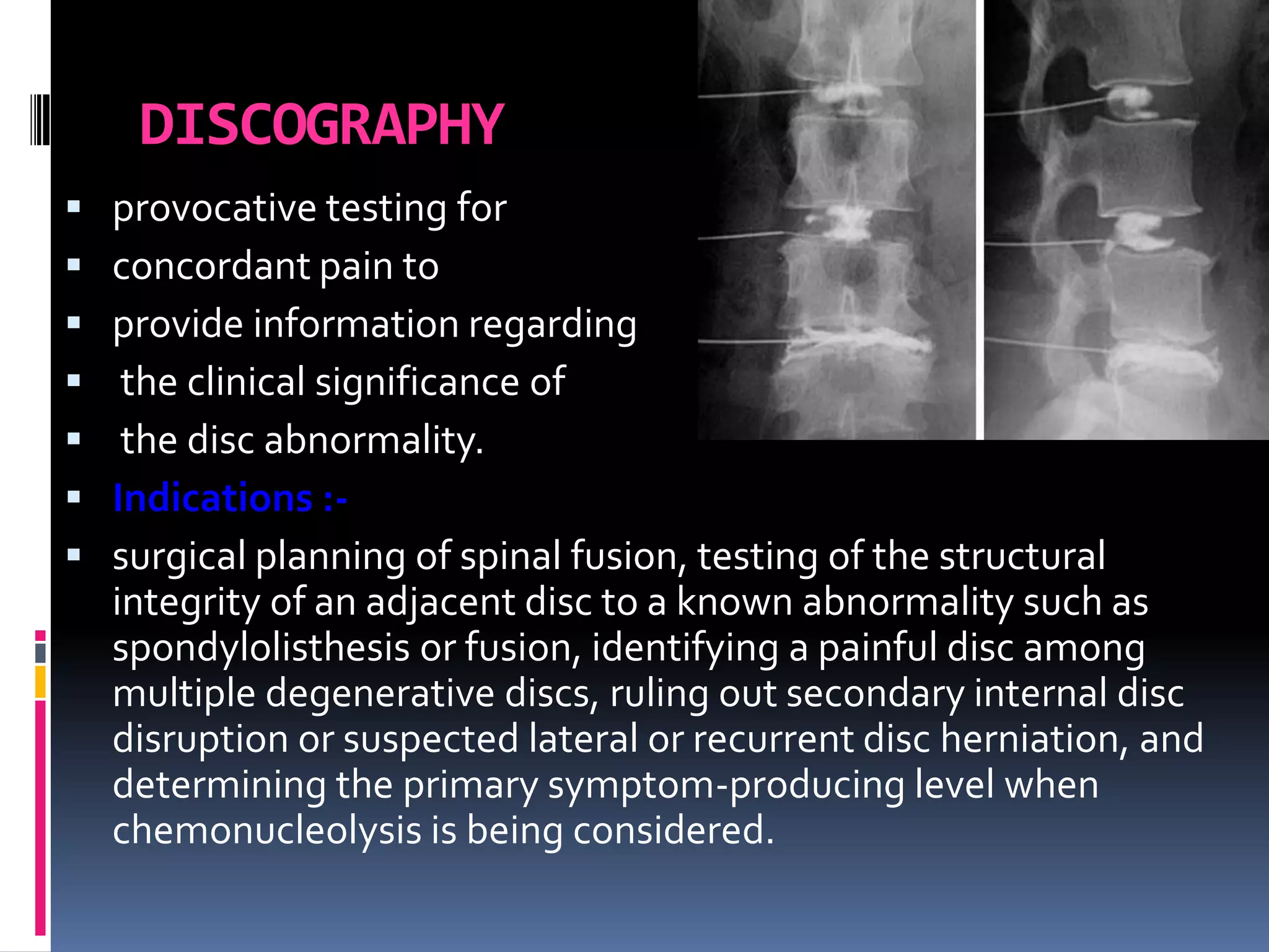 DISCOGRAPHY








provocative testing for
concordant pain to
provide information regarding
the clinical significance of
the disc abnormality.
Indications :surgical planning of spinal fusion, testing of the structural
integrity of an adjacent disc to a known abnormality such as
spondylolisthesis or fusion, identifying a painful disc among
multiple degenerative discs, ruling out secondary internal disc
disruption or suspected lateral or recurrent disc herniation, and
determining the primary symptom-producing level when
chemonucleolysis is being considered.

 