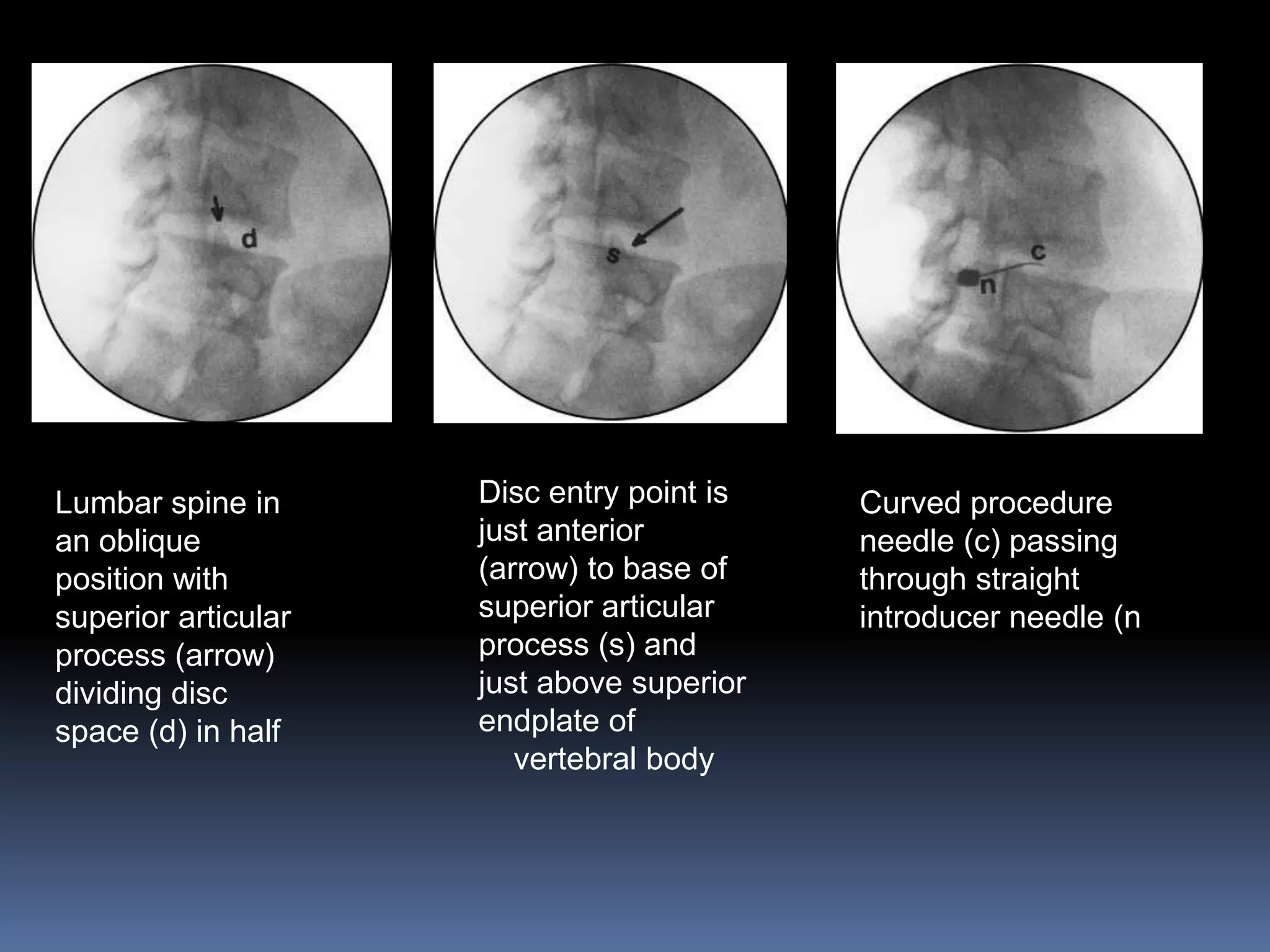 Lumbar spine in
an oblique
position with
superior articular
process (arrow)
dividing disc
space (d) in half

Disc entry point is
just anterior
(arrow) to base of
superior articular
process (s) and
just above superior
endplate of
vertebral body

Curved procedure
needle (c) passing
through straight
introducer needle (n

 