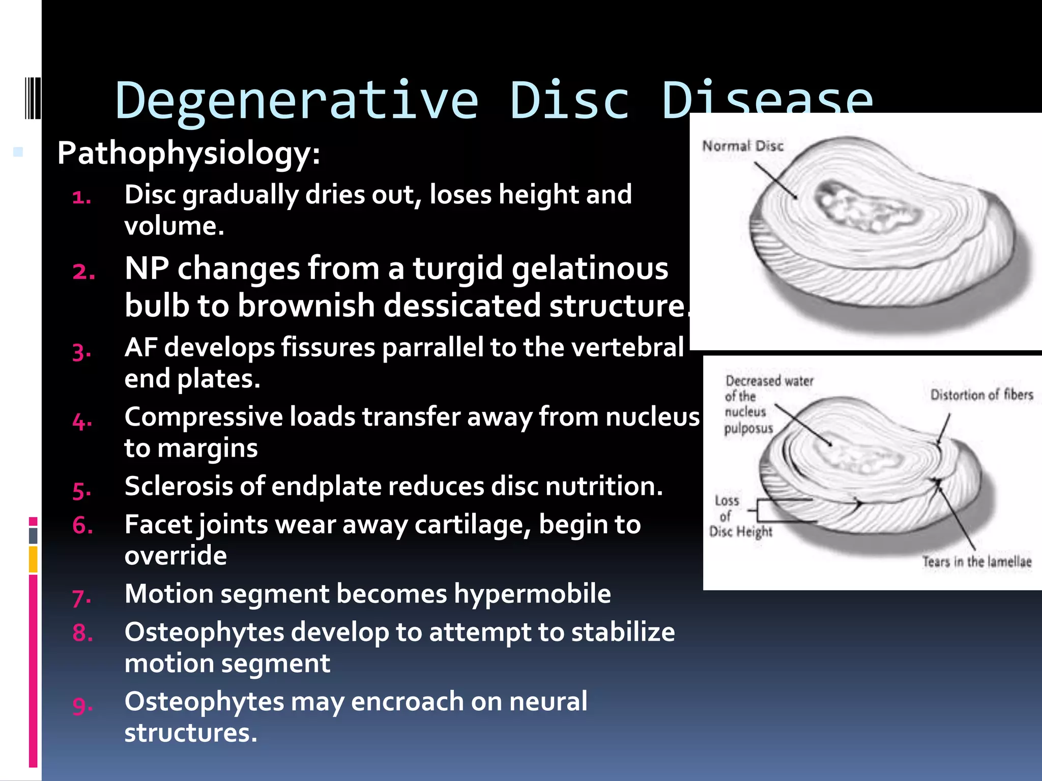 Degenerative Disc Disease
 Pathophysiology:
1.

Disc gradually dries out, loses height and
volume.

2. NP changes from a turgid gelatinous

bulb to brownish dessicated structure.
3.
4.
5.
6.
7.
8.
9.

AF develops fissures parrallel to the vertebral
end plates.
Compressive loads transfer away from nucleus
to margins
Sclerosis of endplate reduces disc nutrition.
Facet joints wear away cartilage, begin to
override
Motion segment becomes hypermobile
Osteophytes develop to attempt to stabilize
motion segment
Osteophytes may encroach on neural
structures.

 