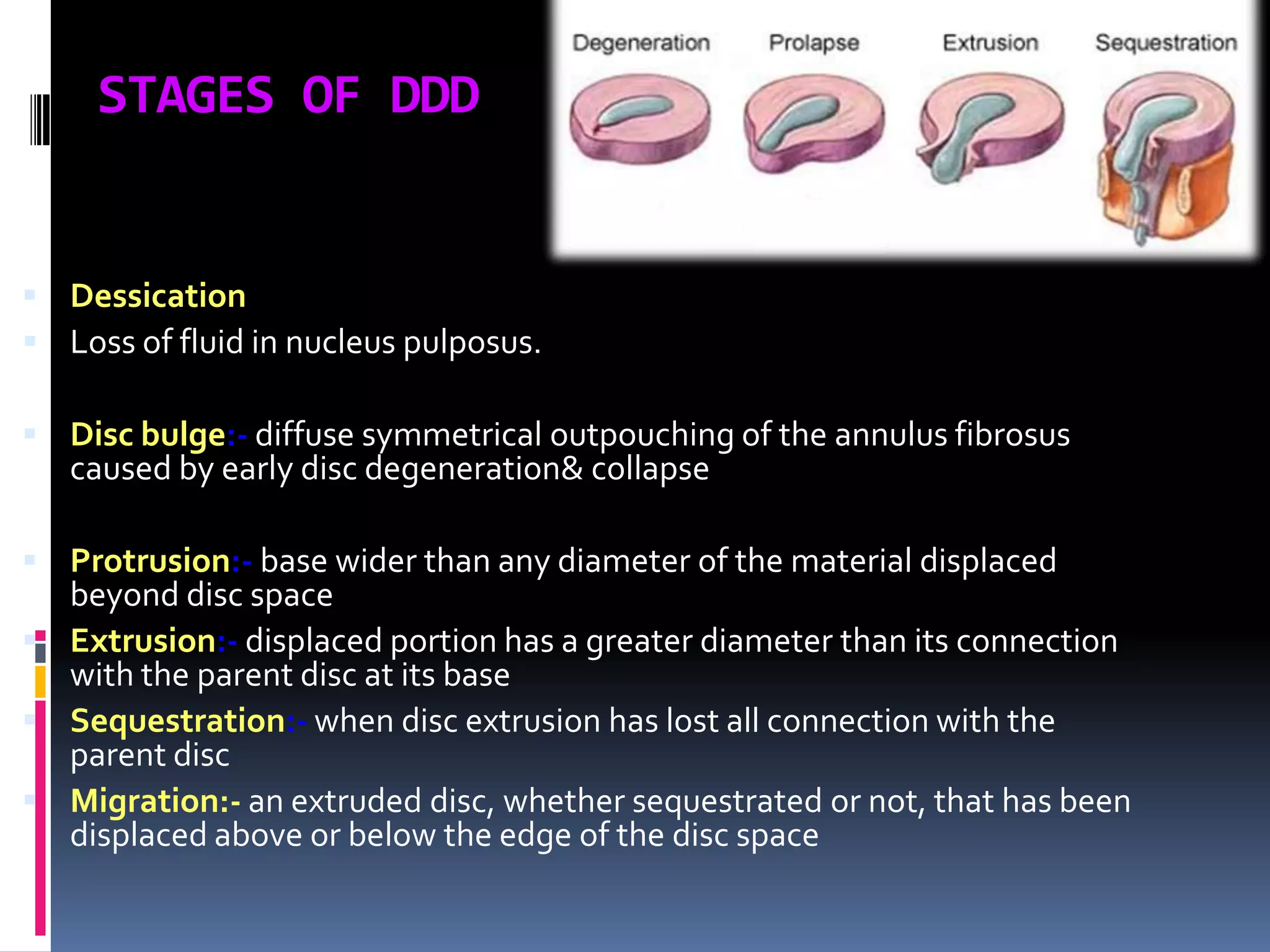 STAGES OF DDD

 Dessication
 Loss of fluid in nucleus pulposus.
 Disc bulge:- diffuse symmetrical outpouching of the annulus fibrosus

caused by early disc degeneration& collapse

 Protrusion:- base wider than any diameter of the material displaced

beyond disc space
 Extrusion:- displaced portion has a greater diameter than its connection
with the parent disc at its base
 Sequestration:- when disc extrusion has lost all connection with the
parent disc
 Migration:- an extruded disc, whether sequestrated or not, that has been
displaced above or below the edge of the disc space

 