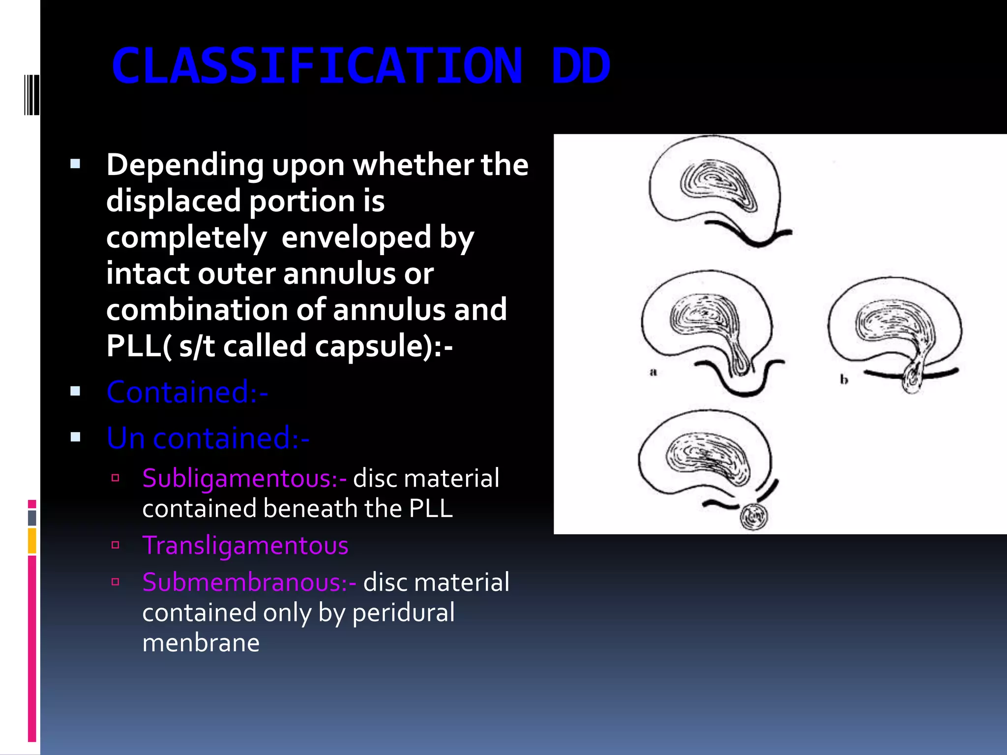 CLASSIFICATION DD
 Depending upon whether the

displaced portion is
completely enveloped by
intact outer annulus or
combination of annulus and
PLL( s/t called capsule): Contained: Un contained: Subligamentous:- disc material

contained beneath the PLL
 Transligamentous
 Submembranous:- disc material
contained only by peridural
menbrane

 
