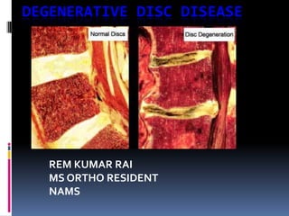 DEGENERATIVE DISC DISEASE

REM KUMAR RAI
MS ORTHO RESIDENT
NAMS

 