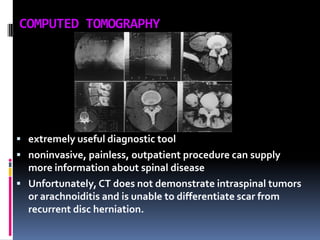 COMPUTED TOMOGRAPHY

 extremely useful diagnostic tool
 noninvasive, painless, outpatient procedure can supply

more information about spinal disease
 Unfortunately, CT does not demonstrate intraspinal tumors
or arachnoiditis and is unable to differentiate scar from
recurrent disc herniation.

 