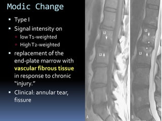 Modic Change
 Type I
 Signal intensity on
 low T1-weighted

 High T2-weighted

 replacement of the
end-plate marrow with

vascular fibrous tissue
in response to chronic
“injury.”
 Clinical: annular tear,
fissure

 