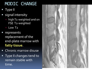 MODIC CHANGE
 Type II
 signal intensity
 high T1-weighted and on

FSE T2-weighted
 Low T2

 represents
replacement of the
end-plate marrow with
fatty tissue.
 Chronic marrow disuse

 Type II changes tend to
remain stable with
time.

 