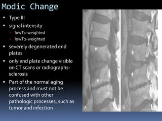 Modic Change
 Type III
 signal intensity
 lowT1-weighted
 lowT2-weighted

 severely degenerated end

plates
 only end plate change visible
on CT scans or radiographssclerosis
 Part of the normal aging
process and must not be
confused with other
pathologic processes, such as
tumor and infection

 