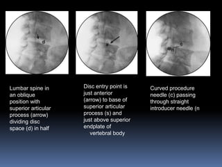 Lumbar spine in
an oblique
position with
superior articular
process (arrow)
dividing disc
space (d) in half

Disc entry point is
just anterior
(arrow) to base of
superior articular
process (s) and
just above superior
endplate of
vertebral body

Curved procedure
needle (c) passing
through straight
introducer needle (n

 