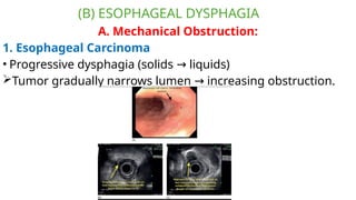 Comprehensive Differential Diagnosis and Management of Dysphagia | PPTX