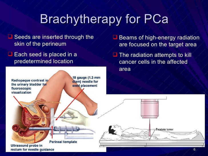 D de Jong, Prostate cancer brachytherapy