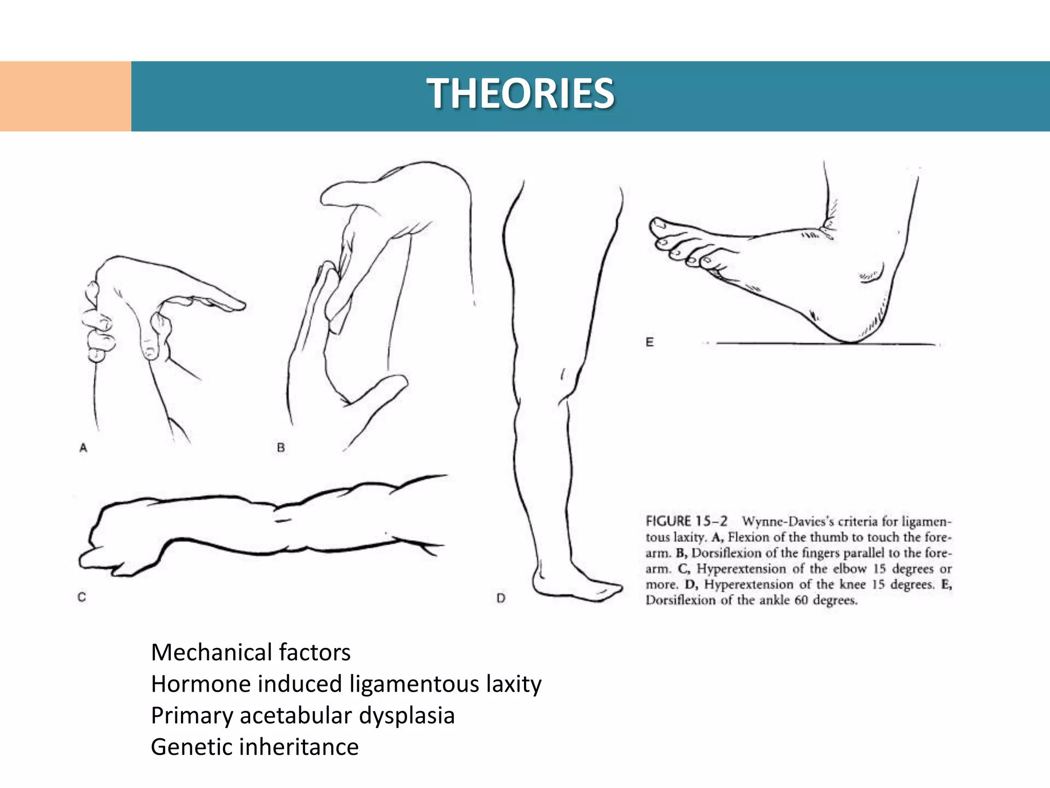 THEORIES




Mechanical factors
Hormone induced ligamentous laxity
Primary acetabular dysplasia
Genetic inheritance
 