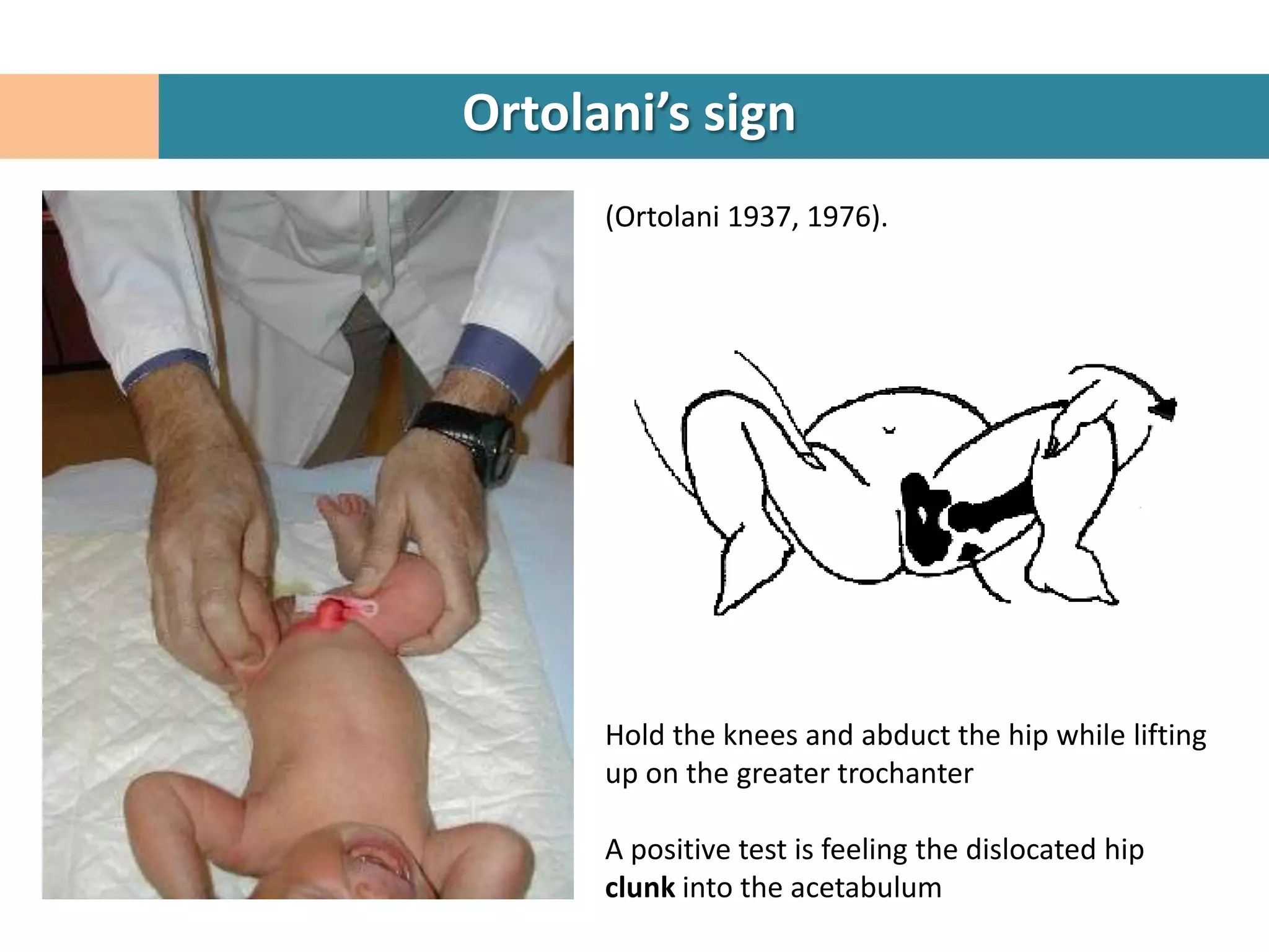 Ortolani’s sign
      (Ortolani 1937, 1976).




      Hold the knees and abduct the hip while lifting
      up on the greater trochanter

      A positive test is feeling the dislocated hip
      clunk into the acetabulum
 