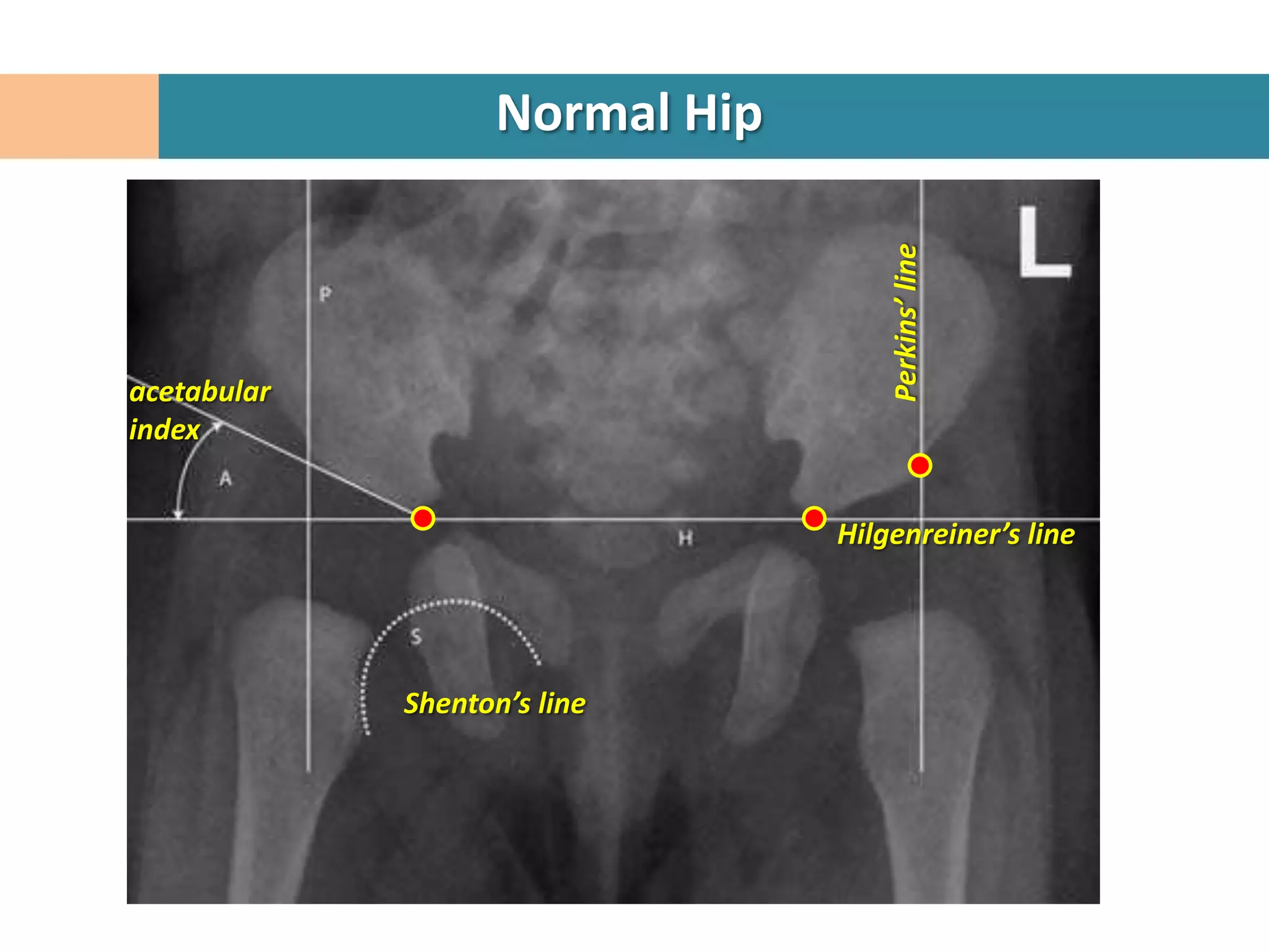 Normal Hip




                                     Perkins’ line
acetabular
index


                                 Hilgenreiner’s line




             Shenton’s line
 