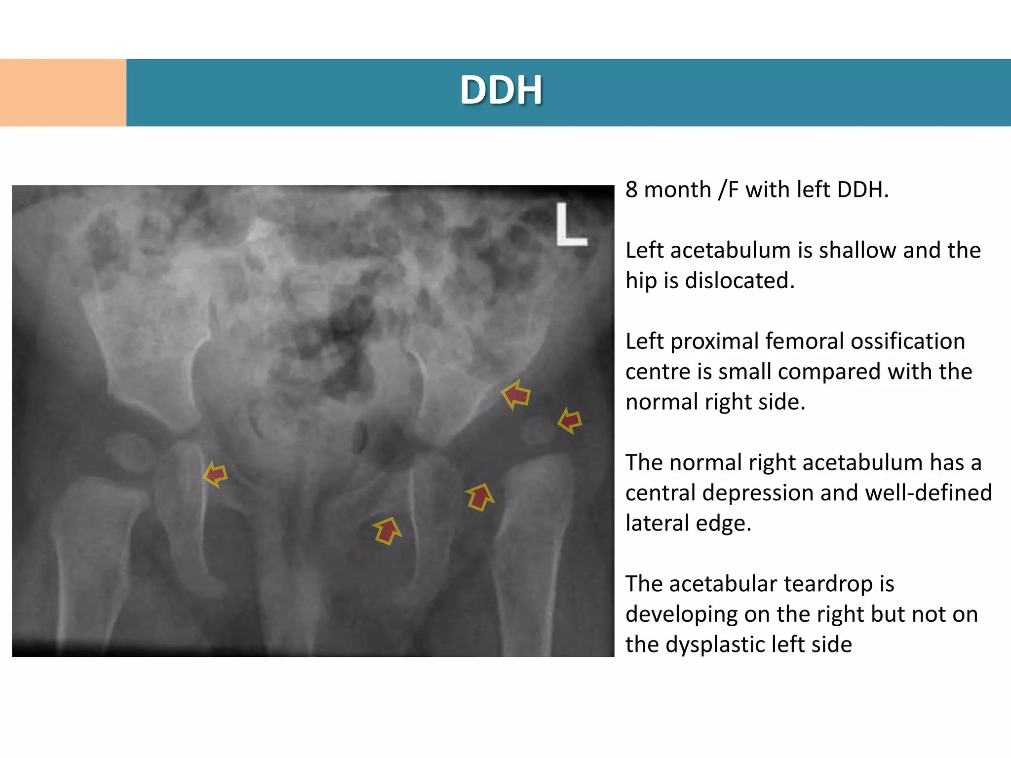 DDH

      8 month /F with left DDH.

      Left acetabulum is shallow and the
      hip is dislocated.

      Left proximal femoral ossification
      centre is small compared with the
      normal right side.

      The normal right acetabulum has a
      central depression and well-defined
      lateral edge.

      The acetabular teardrop is
      developing on the right but not on
      the dysplastic left side
 