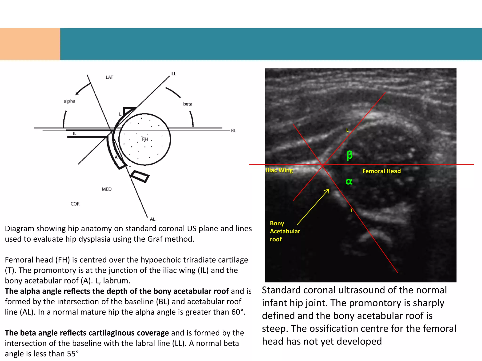 L




                                                                                            β
                                                                         Iliac Wing                 Femoral Head
                                                                                            α

                                                                                                T

                                                                          Bony
Diagram showing hip anatomy on standard coronal US plane and lines        Acetabular
used to evaluate hip dysplasia using the Graf method.                     roof


Femoral head (FH) is centred over the hypoechoic triradiate cartilage
(T). The promontory is at the junction of the iliac wing (IL) and the
bony acetabular roof (A). L, labrum.
The alpha angle reflects the depth of the bony acetabular roof and is    Standard coronal ultrasound of the normal
formed by the intersection of the baseline (BL) and acetabular roof      infant hip joint. The promontory is sharply
line (AL). In a normal mature hip the alpha angle is greater than 60°.
                                                                         defined and the bony acetabular roof is
The beta angle reflects cartilaginous coverage and is formed by the      steep. The ossification centre for the femoral
intersection of the baseline with the labral line (LL). A normal beta    head has not yet developed
angle is less than 55°
 