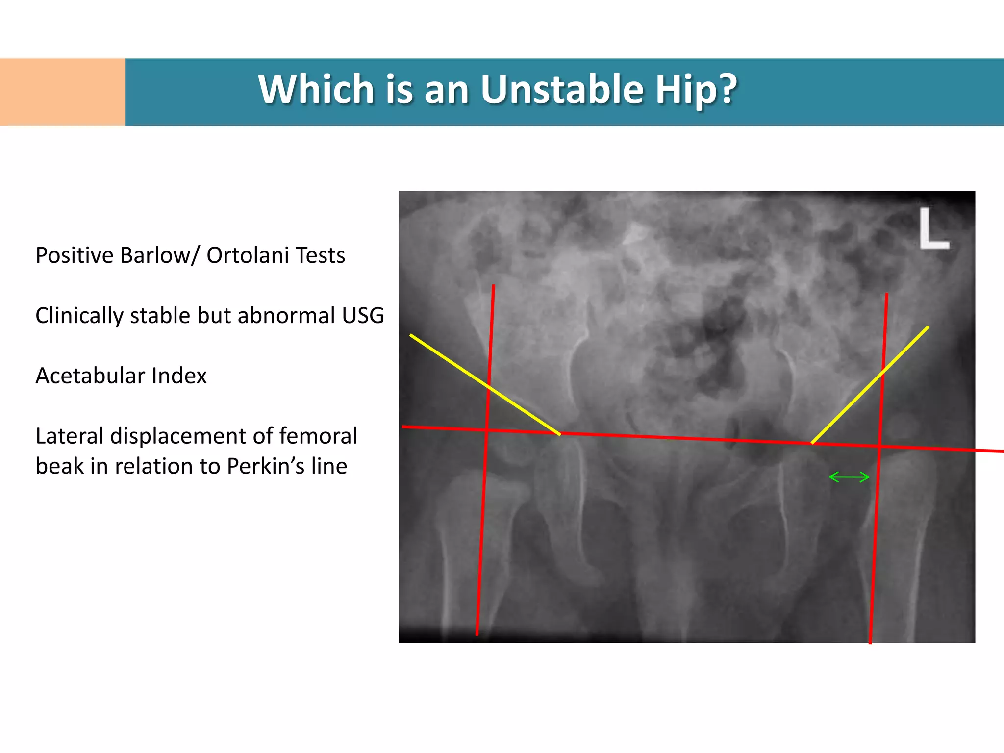 Which is an Unstable Hip?


Positive Barlow/ Ortolani Tests

Clinically stable but abnormal USG

Acetabular Index

Lateral displacement of femoral
beak in relation to Perkin’s line
 