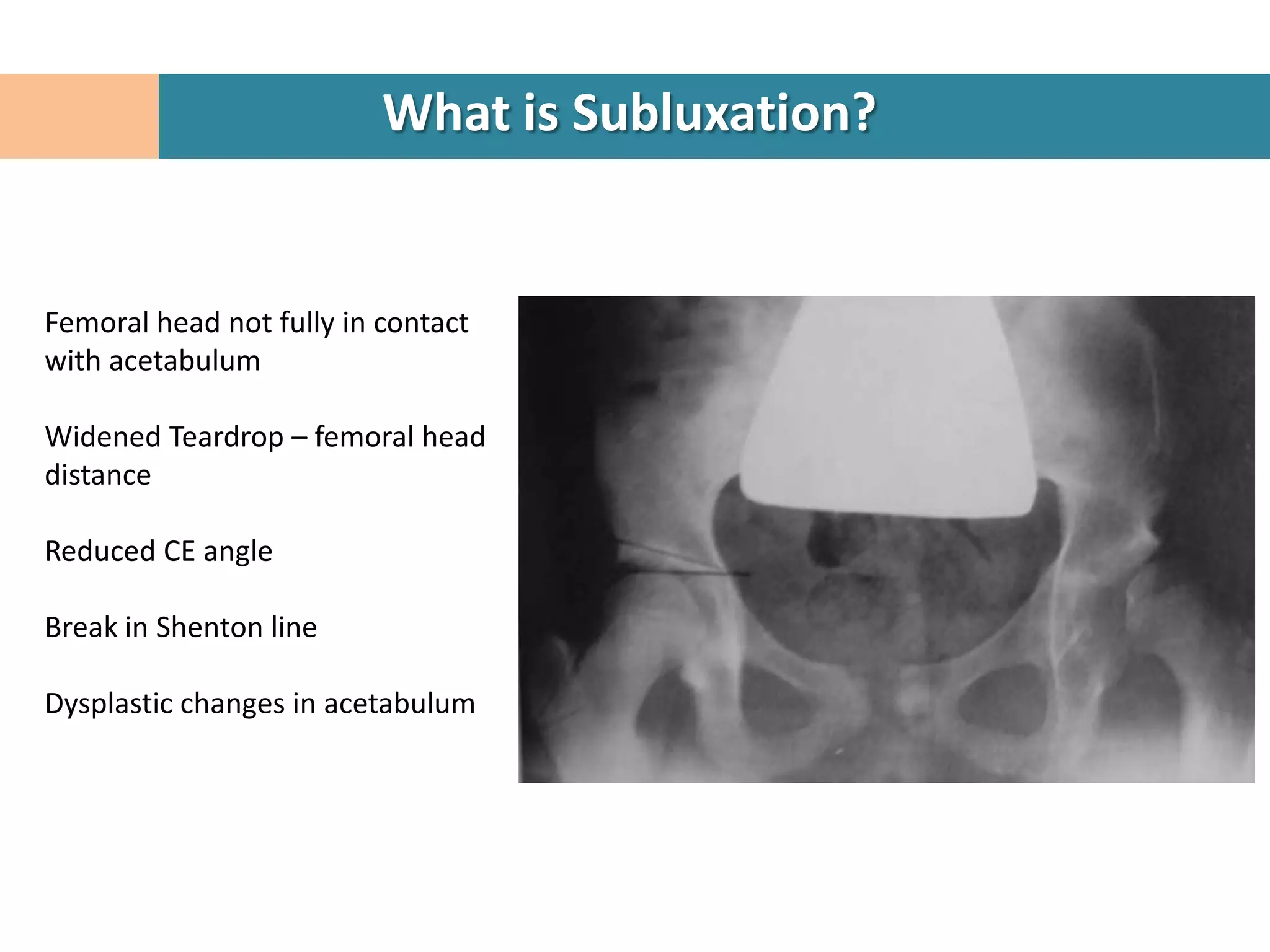 What is Subluxation?


Femoral head not fully in contact
with acetabulum

Widened Teardrop – femoral head
distance

Reduced CE angle

Break in Shenton line

Dysplastic changes in acetabulum
 