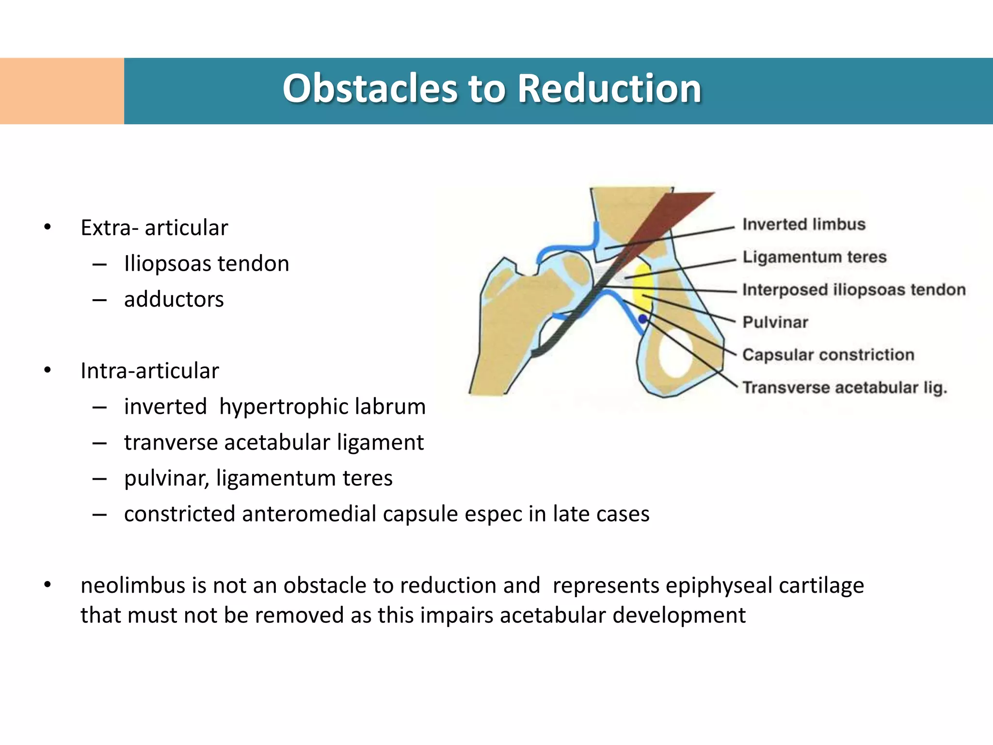 Obstacles to Reduction


•   Extra- articular
     – Iliopsoas tendon
     – adductors

•   Intra-articular
     – inverted hypertrophic labrum
     – tranverse acetabular ligament
     – pulvinar, ligamentum teres
     – constricted anteromedial capsule espec in late cases

•   neolimbus is not an obstacle to reduction and represents epiphyseal cartilage
    that must not be removed as this impairs acetabular development
 