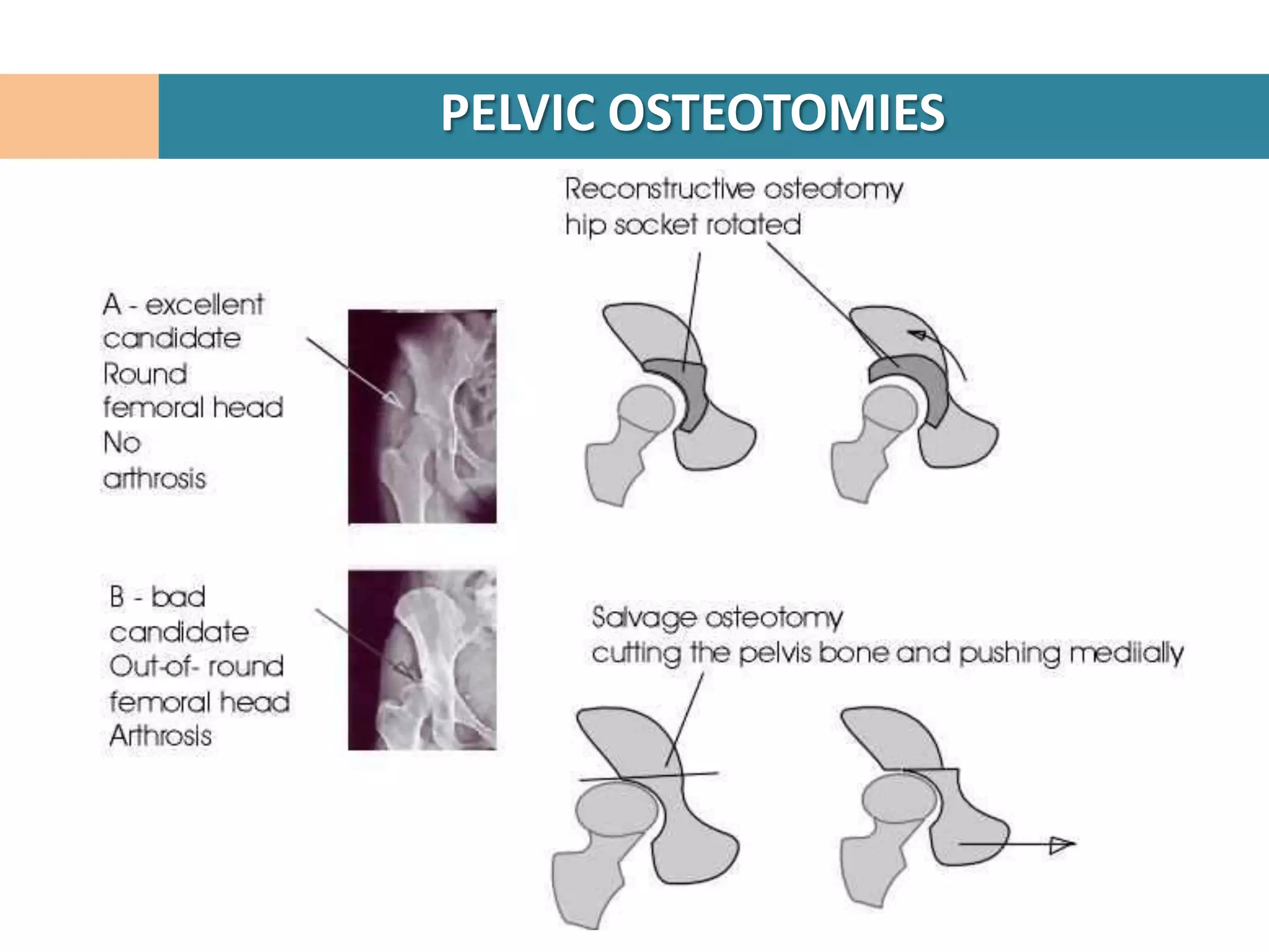 PELVIC OSTEOTOMIES
 