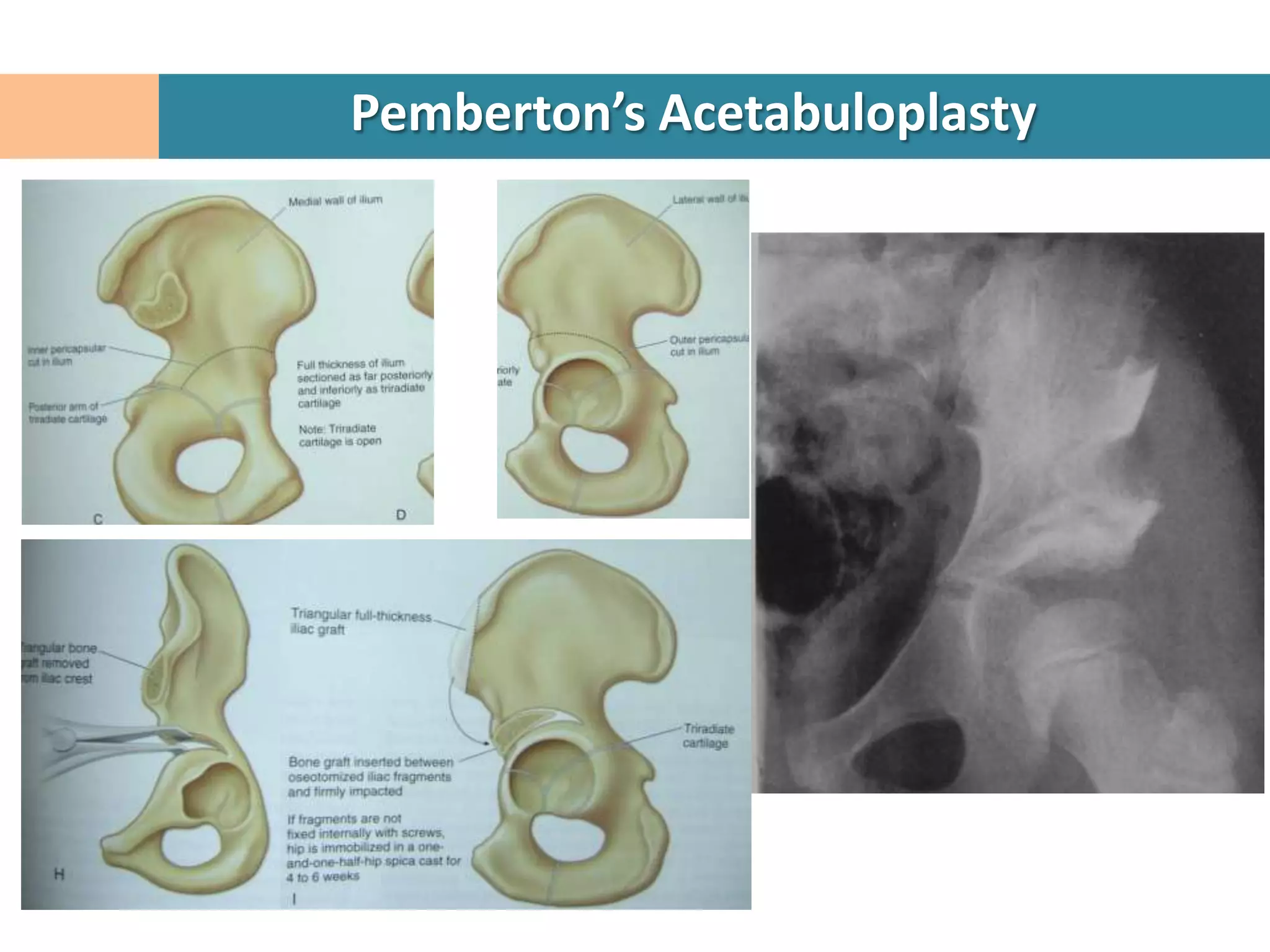 Pemberton’s Acetabuloplasty
 