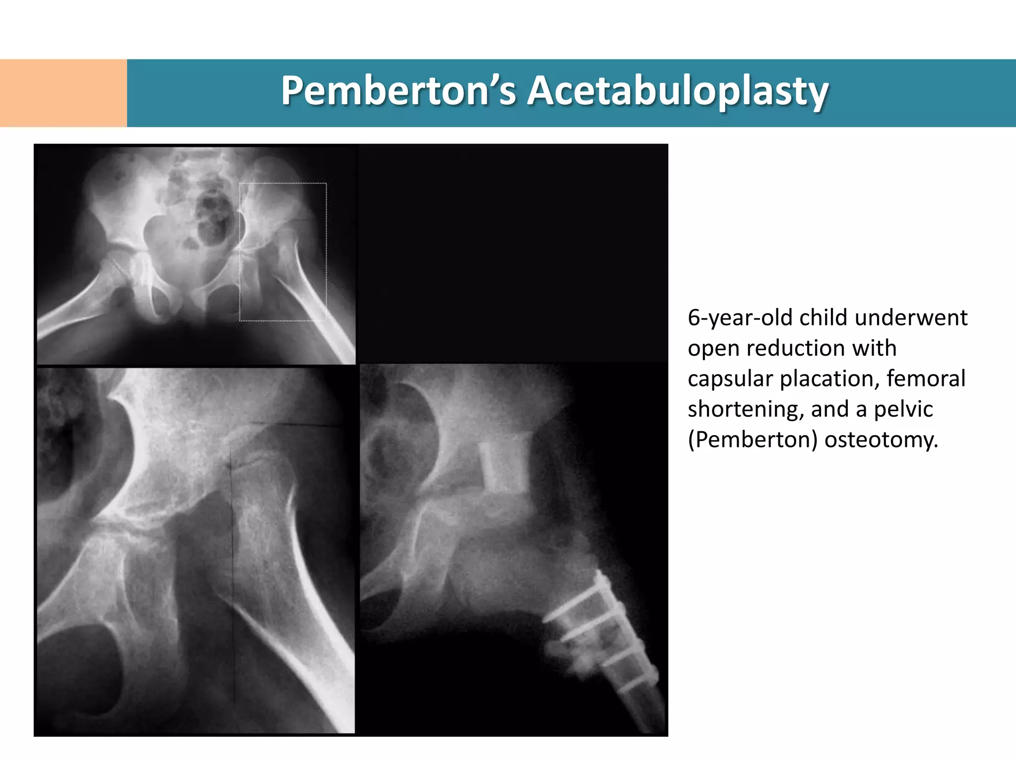 Pemberton’s Acetabuloplasty



                    6-year-old child underwent
                    open reduction with
                    capsular placation, femoral
                    shortening, and a pelvic
                    (Pemberton) osteotomy.
 