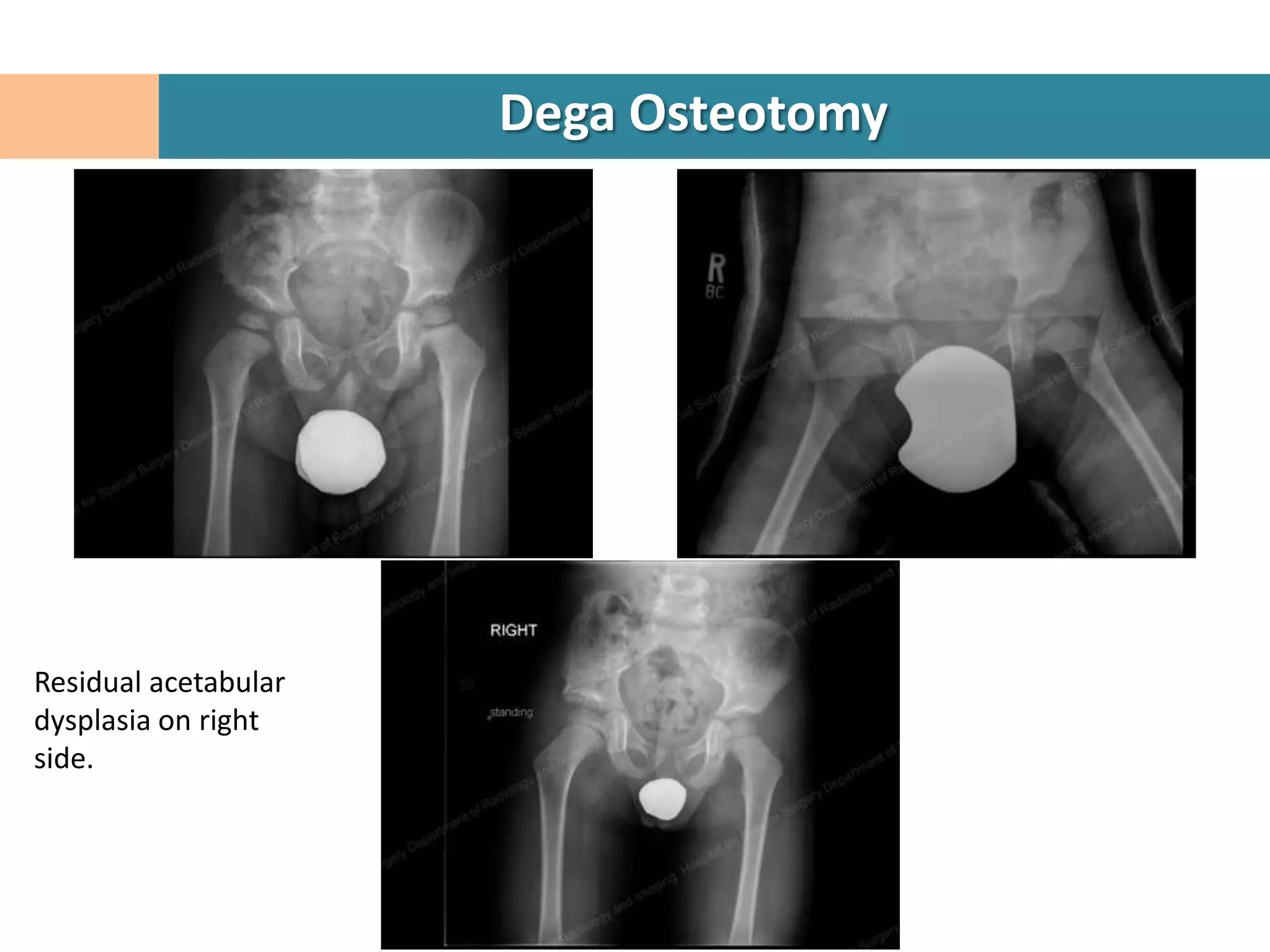 Dega Osteotomy




Residual acetabular
dysplasia on right
side.
 