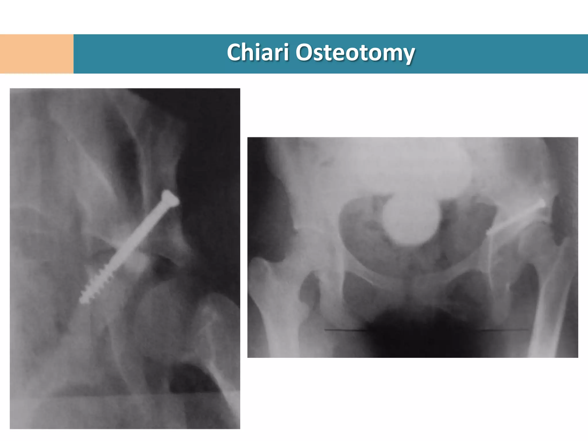 Chiari Osteotomy
 