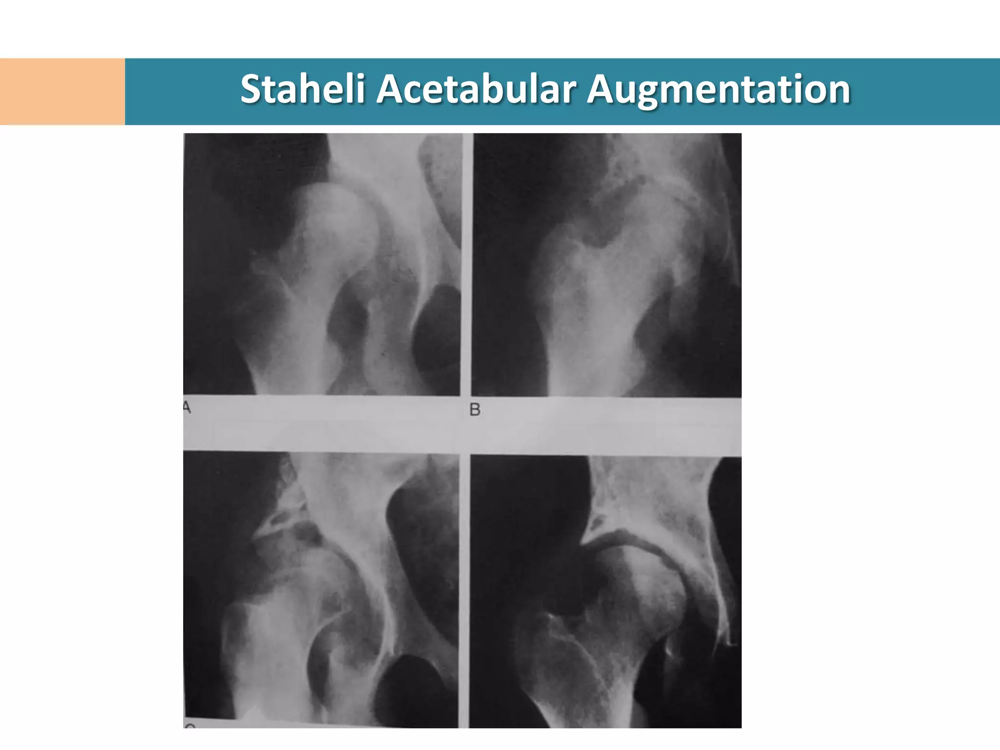 Staheli Acetabular Augmentation
 