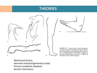 THEORIES




Mechanical factors
Hormone induced ligamentous laxity
Primary acetabular dysplasia
Genetic inheritance
 