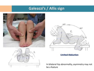 Galeazzi’s / Allis sign




                         Limited Abduction



           In bilateral hip abnormality, asymmetry may not
           be a feature
 