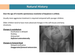Natural History

Over the age of 6 months spontaneous resolution of dysplasia is unlikely

Usually more aggressive treatment is required compared with younger children.

Older children tend to have more advanced changes in the soft tissues and bony
structures.

Changes in acetabulum
         Ossification is delayed
         Shallow,
         Anteverted
         Deficient anterolaterally.

Changes in Femoral Head
         Delayed ossification
         Exaggerated femoral anteversion.
 
