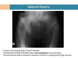 Natural History




A 16y /F with longstanding “missed” left DDH.
The left femoral head articulates with a neo-acetabulum in the iliac bone.
The left femoral shaft is reduced in diameter and there is wasting of the thigh muscles
 