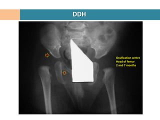 DDH




      Ossification centre
      Head of femur
      2 and 7 months
 