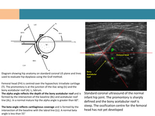 L




                                                                                            β
                                                                         Iliac Wing                 Femoral Head
                                                                                            α

                                                                                                T

                                                                          Bony
Diagram showing hip anatomy on standard coronal US plane and lines        Acetabular
used to evaluate hip dysplasia using the Graf method.                     roof


Femoral head (FH) is centred over the hypoechoic triradiate cartilage
(T). The promontory is at the junction of the iliac wing (IL) and the
bony acetabular roof (A). L, labrum.
The alpha angle reflects the depth of the bony acetabular roof and is    Standard coronal ultrasound of the normal
formed by the intersection of the baseline (BL) and acetabular roof      infant hip joint. The promontory is sharply
line (AL). In a normal mature hip the alpha angle is greater than 60°.
                                                                         defined and the bony acetabular roof is
The beta angle reflects cartilaginous coverage and is formed by the      steep. The ossification centre for the femoral
intersection of the baseline with the labral line (LL). A normal beta    head has not yet developed
angle is less than 55°
 