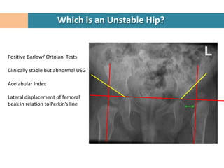Which is an Unstable Hip?


Positive Barlow/ Ortolani Tests

Clinically stable but abnormal USG

Acetabular Index

Lateral displacement of femoral
beak in relation to Perkin’s line
 