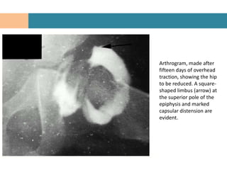 Arthrogram, made after
fifteen days of overhead
traction, showing the hip
to be reduced. A square-
shaped limbus (arrow) at
the superior pole of the
epiphysis and marked
capsular distension are
evident.
 