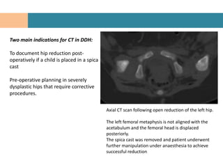 Two main indications for CT in DDH:

To document hip reduction post-
operatively if a child is placed in a spica
cast

Pre-operative planning in severely
dysplastic hips that require corrective
procedures.

                                              Axial CT scan following open reduction of the left hip.

                                              The left femoral metaphysis is not aligned with the
                                              acetabulum and the femoral head is displaced
                                              posteriorly.
                                              The spica cast was removed and patient underwent
                                              further manipulation under anaesthesia to achieve
                                              successful reduction
 