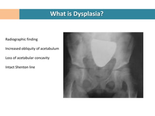 What is Dysplasia?


Radiographic finding

Increased obliquity of acetabulum

Loss of acetabular concavity

Intact Shenton line
 
