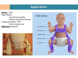Application
Flexion – 120°
Hyper flexion
          Femoral nerve palsy
          Inferior dislocation of head
Inadequate flexion < 90°
          Fails to reduce hip
Abduction by gravity
                                                           1



                                                   4
                                                       3



                                                       2
 