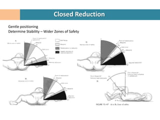 Closed Reduction
Gentle positioning
Determine Stability – Wider Zones of Safety
 