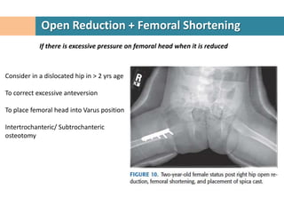 Open Reduction + Femoral Shortening
            If there is excessive pressure on femoral head when it is reduced



Consider in a dislocated hip in > 2 yrs age

To correct excessive anteversion

To place femoral head into Varus position

Intertrochanteric/ Subtrochanteric
osteotomy
 