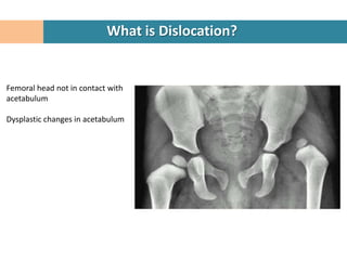 What is Dislocation?


Femoral head not in contact with
acetabulum

Dysplastic changes in acetabulum
 