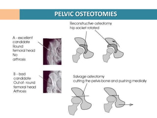 PELVIC OSTEOTOMIES
 