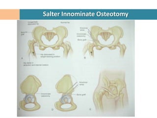 Salter Innominate Osteotomy
 